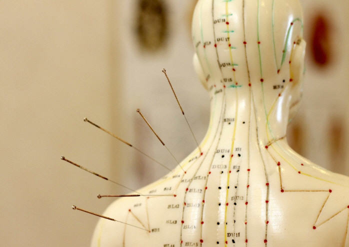 Acupuncture
