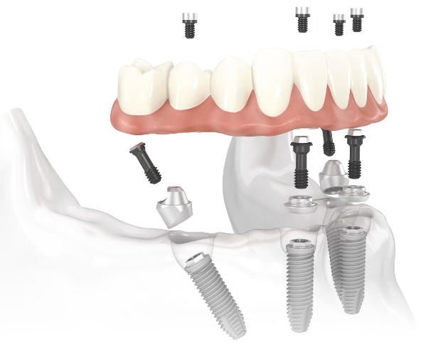 Dental